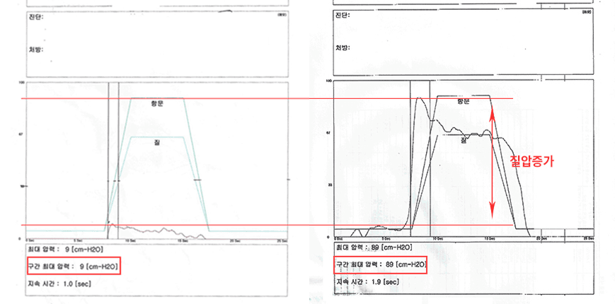 阴道压力改善案例1