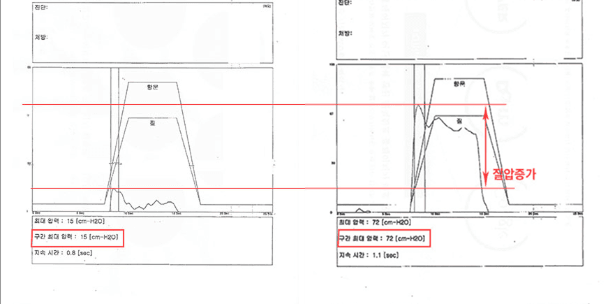 阴道压力改善案例2