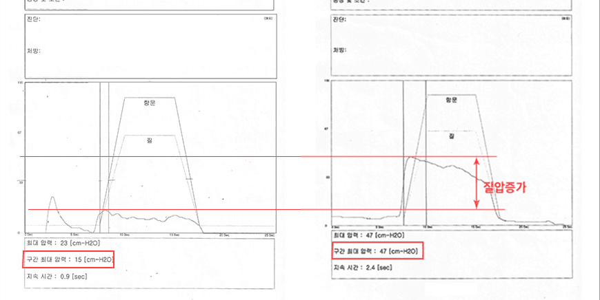 阴道压力改善案例3