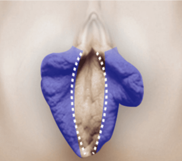 Labia Minora Reshaping