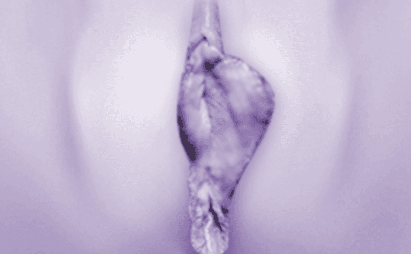 Asymmetric Labia