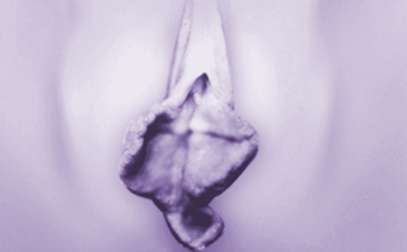 Bilateral Hypertrophy